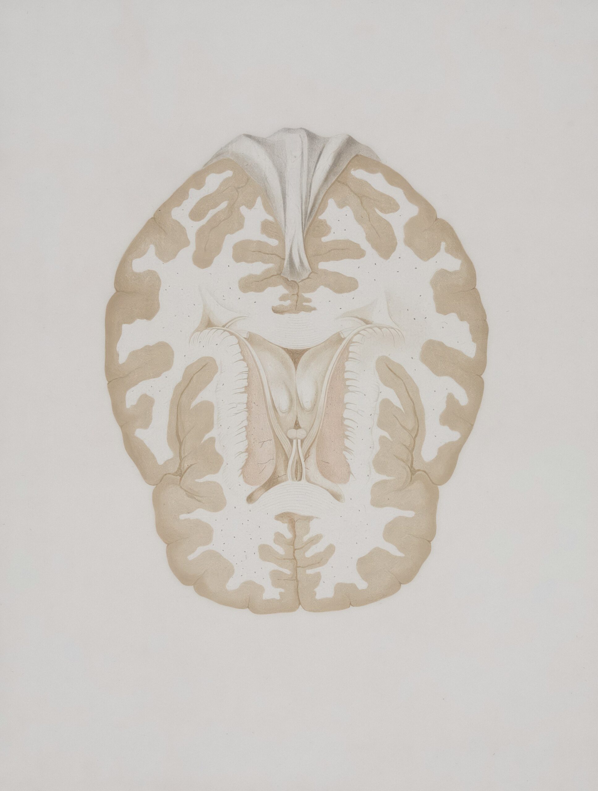 Alzheimer's disease.